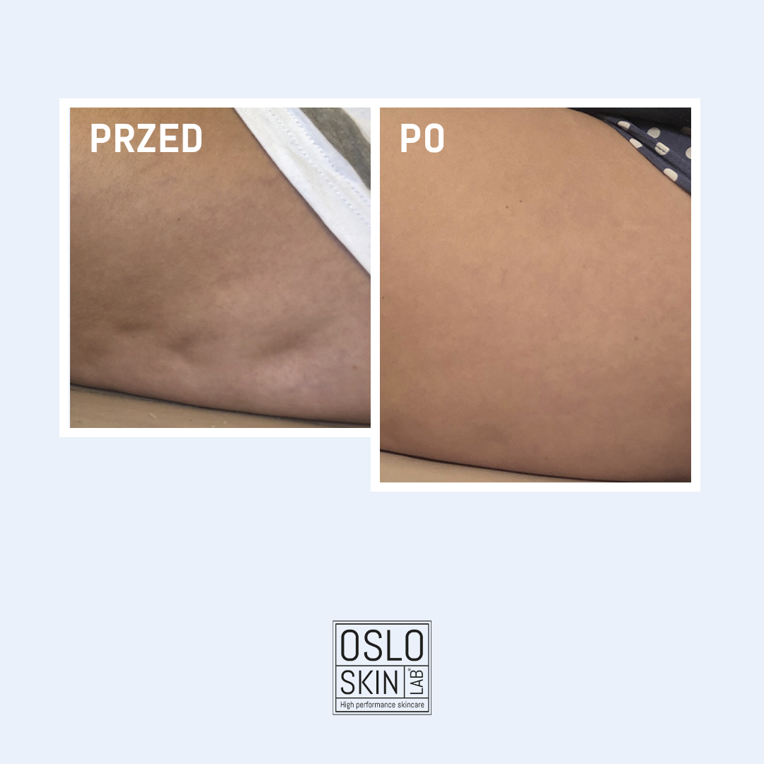 cellulit_PL2.jpg